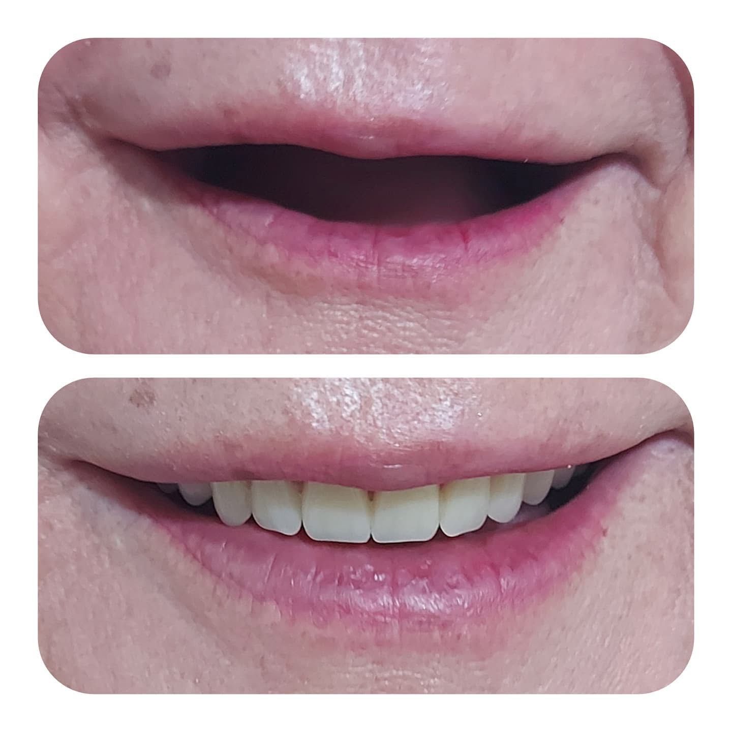 Resultado — Prótesis Dental